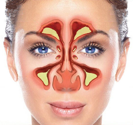 Sinuses and Sinusitis | ENT Doctor Cape Town
