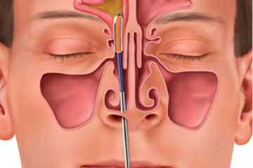 Functional Endoscopic Sinus Surgery | ENT Doctor Cape Town