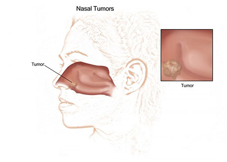 Nasal Cancer | ENT Doctor Cape Town