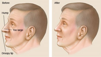 What Is Rhinoplasty | ENT Doctor Cape Town