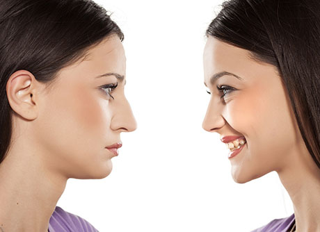 Rhinoplasty | ENT Doctor Cape Town