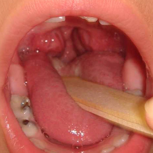 Throat Dr 35