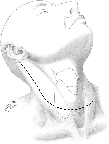 What is Neck Dissection | ENT Doctor Cape Town What is Neck Dissection | ENT Doctor Cape Town