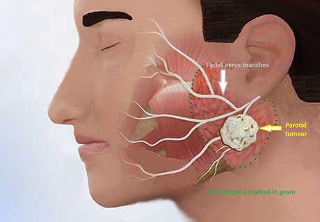 Salivary Gland Cancer | ENT Doctor Cape Town Salivary Gland Cancer | ENT Doctor Cape Town