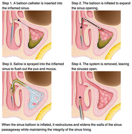 Endoscopic Sinus Surgery | ENT Doctor Cape Town