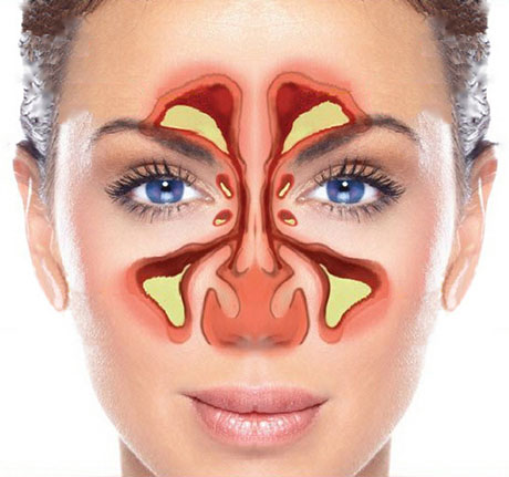 Sinuses and Sinusitis | ENT Doctor Cape Town Sinuses and Sinusitis | ENT Doctor Cape Town