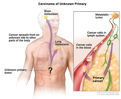 How do Cancers Spread | ENT Doctor Cape Town How do Cancers Spread | ENT Doctor Cape Town