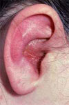 Eczema of the Ear Canal and Pinna | ENT Doctor Cape Town