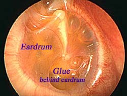 Glue Ear | ENT Doctor Cape Town