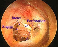 tympanic membrane perforation repair