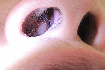Nasal Polyps | ENT Doctor Cape Town Nasal Polyps | ENT Doctor Cape Town