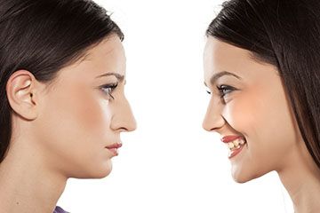 Rhinoplasty | ENT Doctor Cape Town Rhinoplasty | ENT Doctor Cape Town