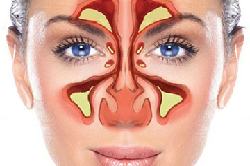 Sinusitis | ENT Doctor Cape Town Sinusitis | ENT Doctor Cape Town