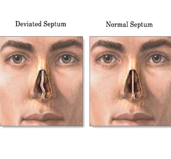 Septal Deviation | ENT Doctor Cape Town Septal Deviation | ENT Doctor Cape Town