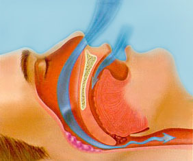 Snoring in kids | ENT Doctor Cape Town