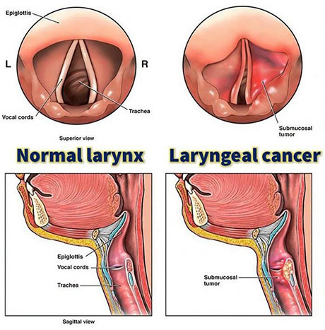 Laryngeal Cancer | ENT Doctor Cape Town