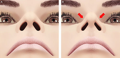 Collapse of Nasal Valves | ENT Doctor Cape Town Collapse of Nasal Valves | ENT Doctor Cape Town