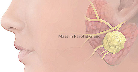 Parotidectomy | ENT Doctor Cape Town