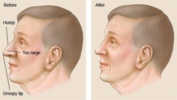 What Is Rhinoplasty | ENT Doctor Cape Town What Is Rhinoplasty | ENT Doctor Cape Town