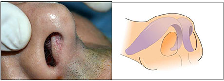 Septal Surgery | ENT Doctor Cape Town Septal Surgery | ENT Doctor Cape Town