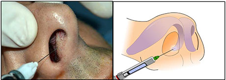 Why Have Septal Surgery | ENT Doctor Cape Town Why Have Septal Surgery | ENT Doctor Cape Town