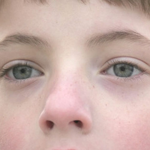 Nasal Injuries | ENT Doctor Cape Town