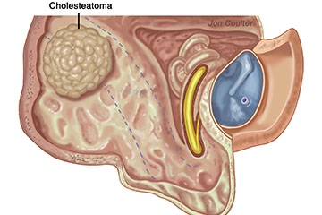 Cholasteatoma and Mastoid Operations | ENT Doctor Cape Town