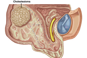 Cholasteatomea and Mastoid Operations | ENT Doctor Cape Town Cholasteatoma and Mastoid Operations | ENT Doctor Cape Town