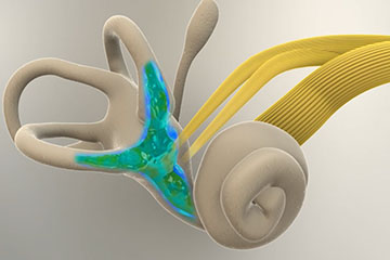 Menieres Disease | ENT Doctor Cape Town Menieres Disease | ENT Doctor Cape Town