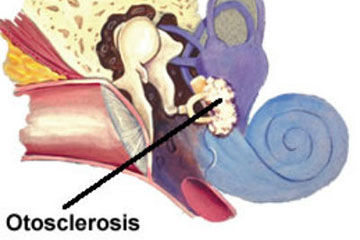Osteosclerosis | ENT Doctor Cape Town Osteosclerosis | ENT Doctor Cape Town