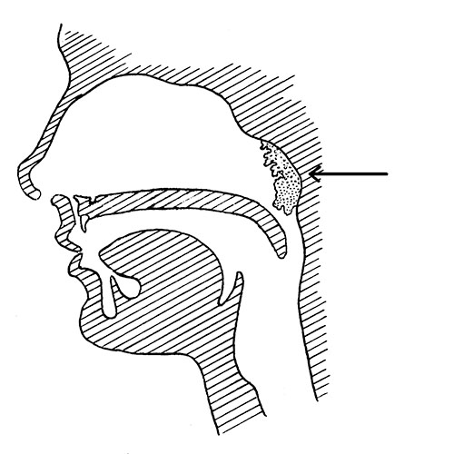 Adenoids | ENT Doctor Cape Town