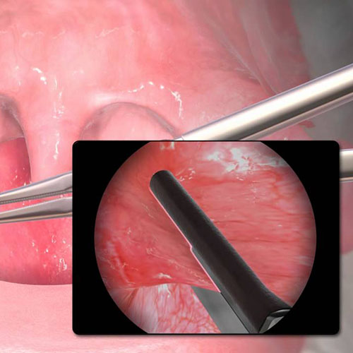 Tonsilectomy | ENT Doctor Cape Town