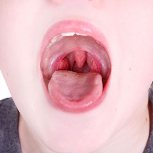 Tonsils | ENT Doctor Cape Town