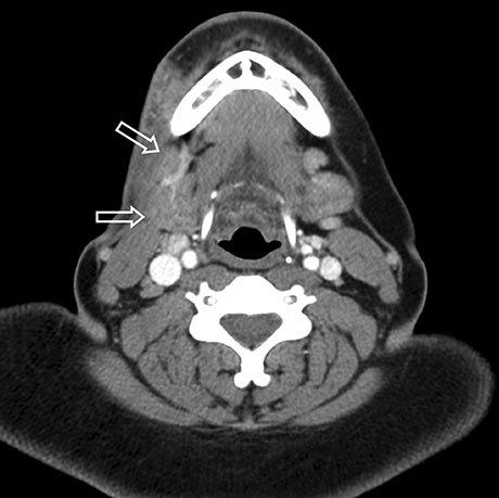 Submandibular Gland Surgery | ENT Doctor Cape Town Submandibular Gland Surgery | ENT Doctor Cape Town