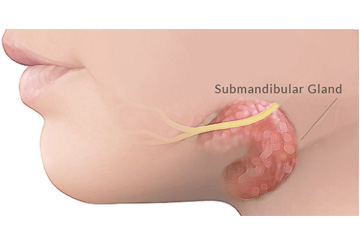 Submandibular Gland Surgery | ENT Doctor Cape Town