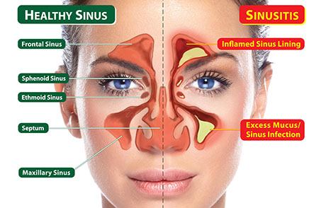 Sinus Infection (Sinusitis), Antibiotic Use